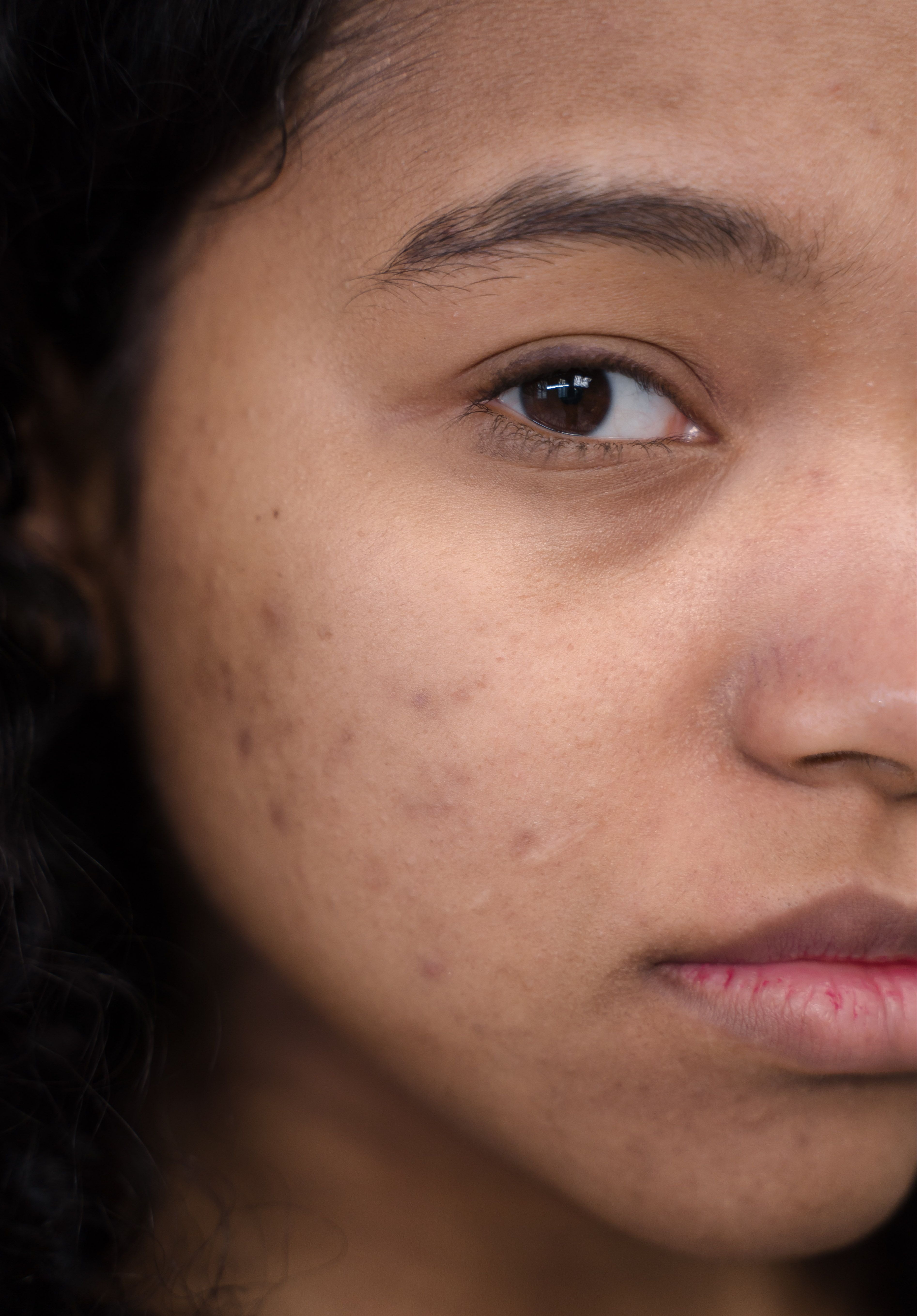 Close-up of a woman's cheek showing acne scarring and blemishes