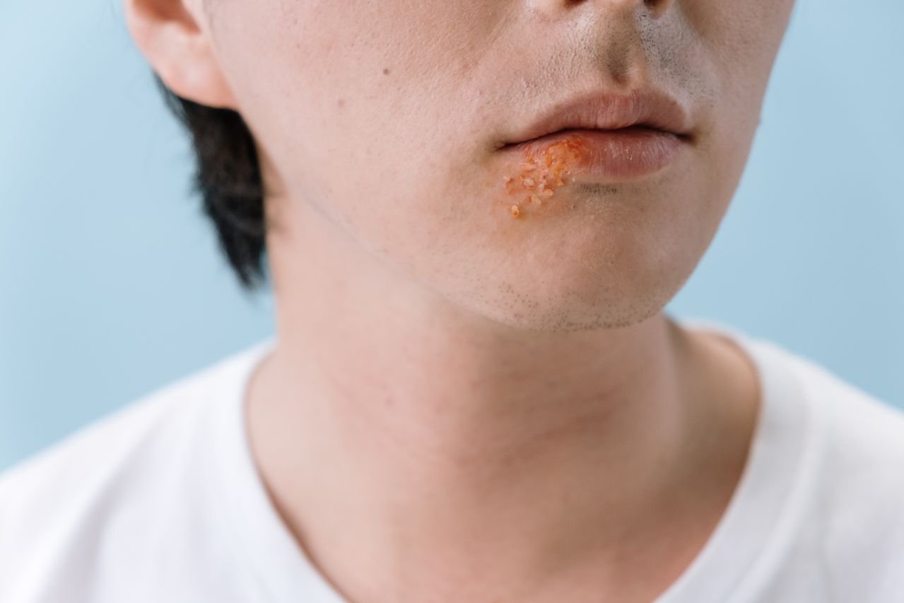 Close-up of a cold sore on a young man's lower lip