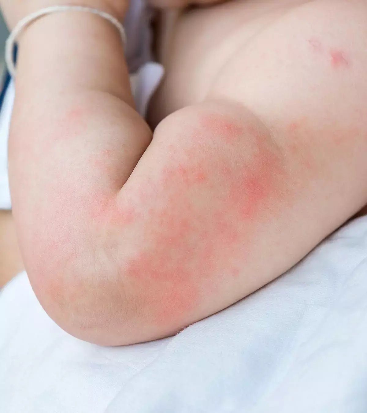 Hives-In-Babies-Causes-Treatment-Home-Remedies-1-1.jpg