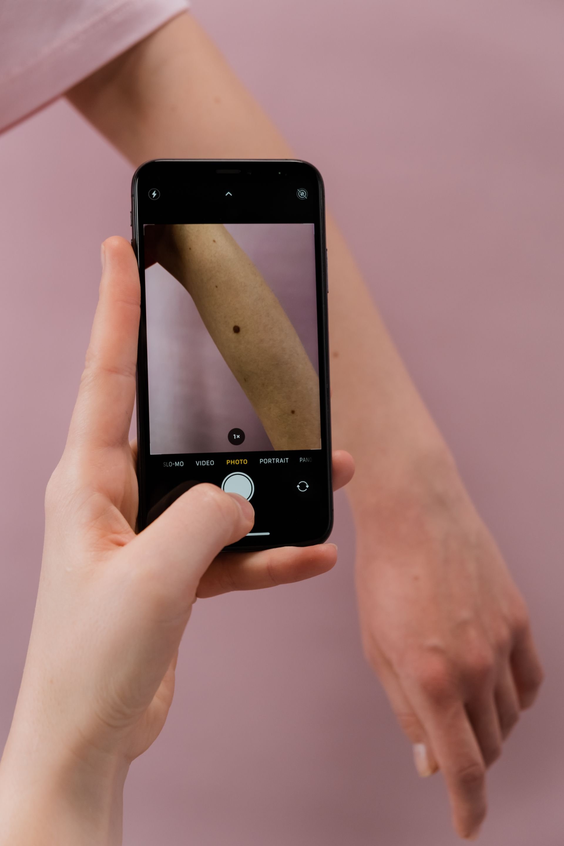 camera on phone showing mole on arm