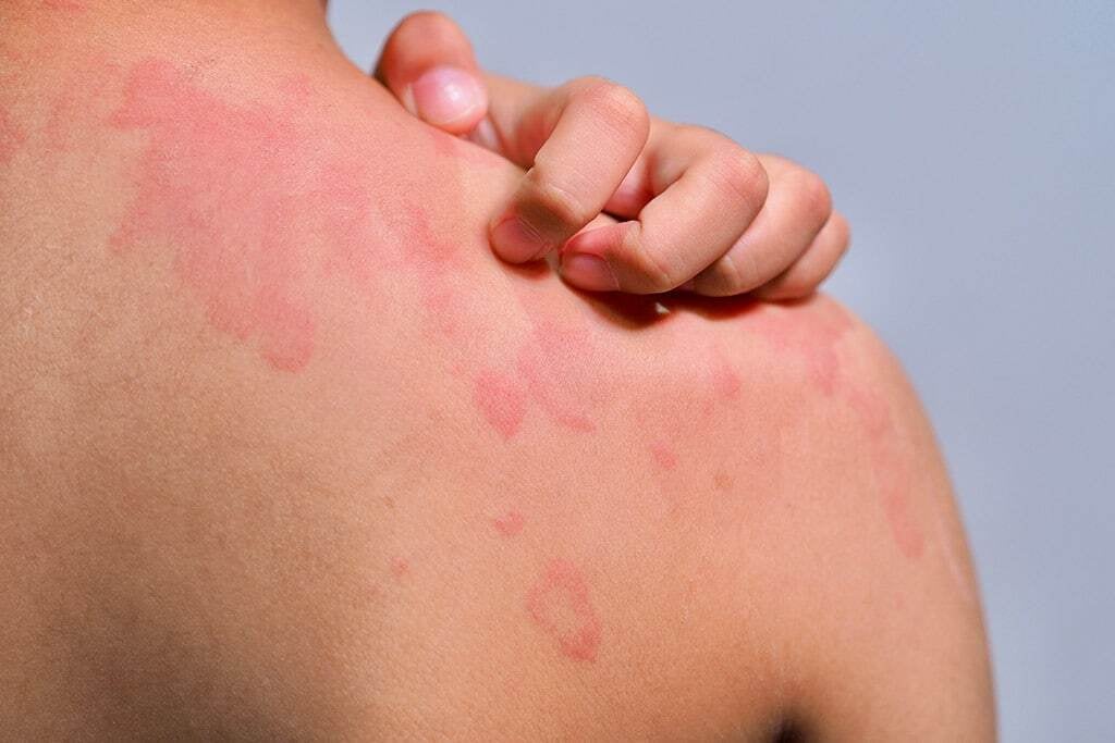 skin-hives