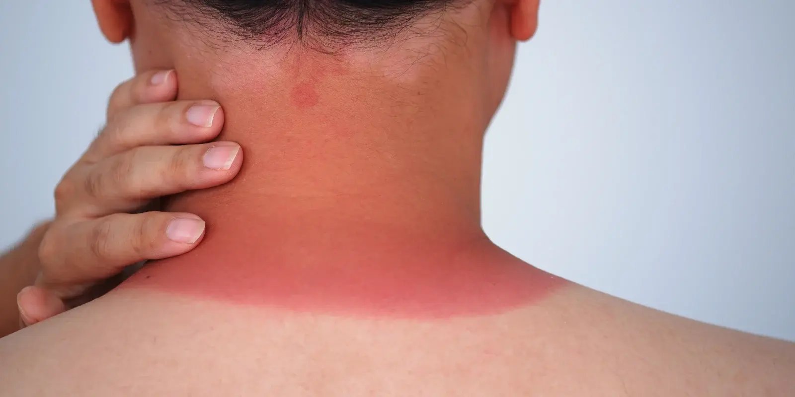 Man with sunburn on neck