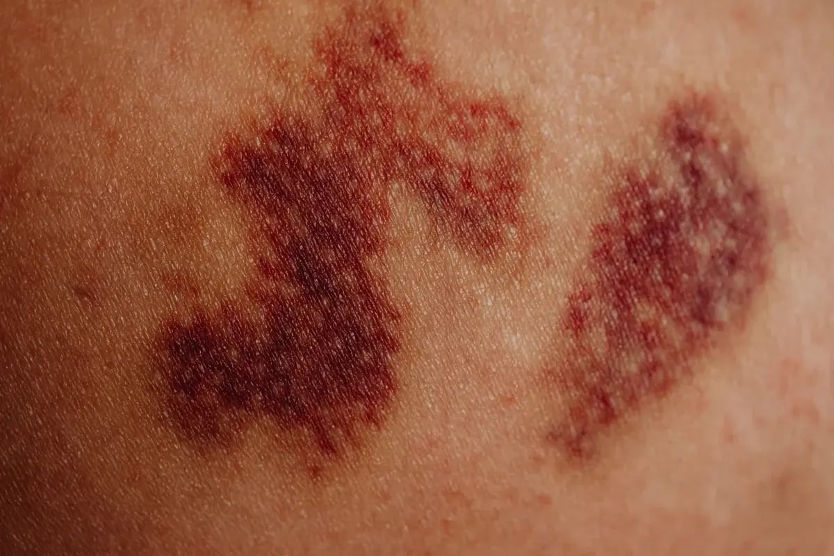 bruise-skin-closeup