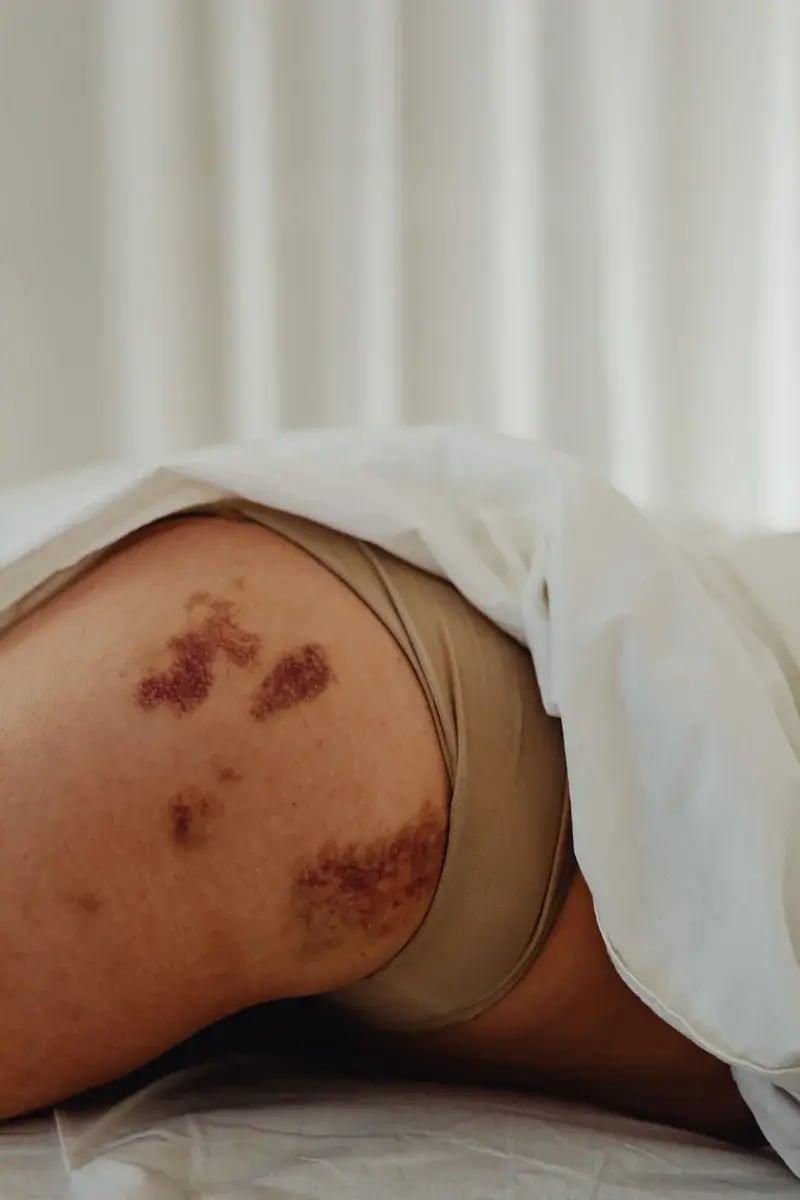 bruising-hip-lying-in-bed