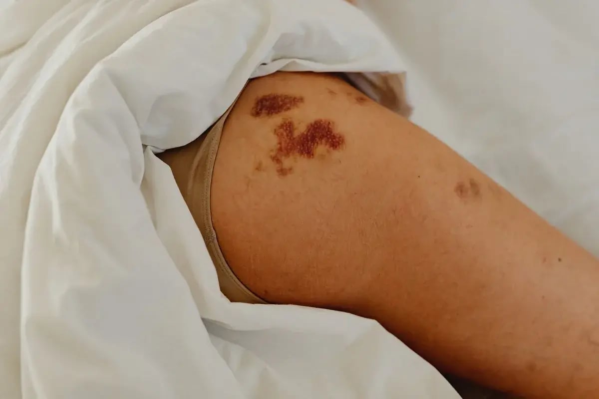bruising-upper-thigh