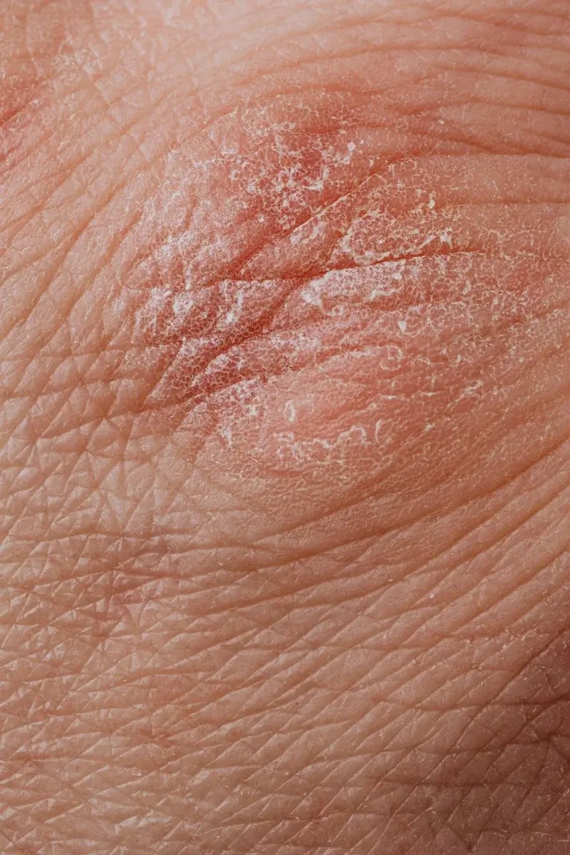 dry-flaky-skin-closeup