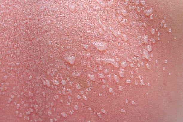 sun burn blister