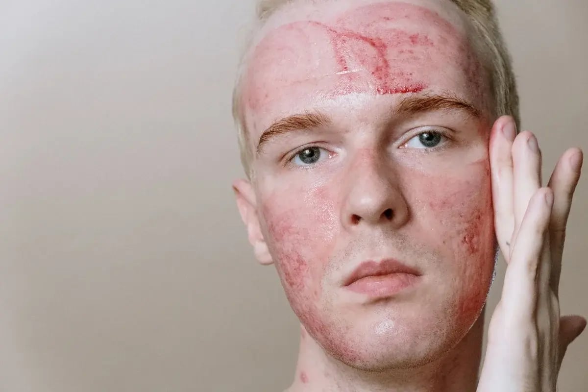 man-facial-skin-redness-irritation