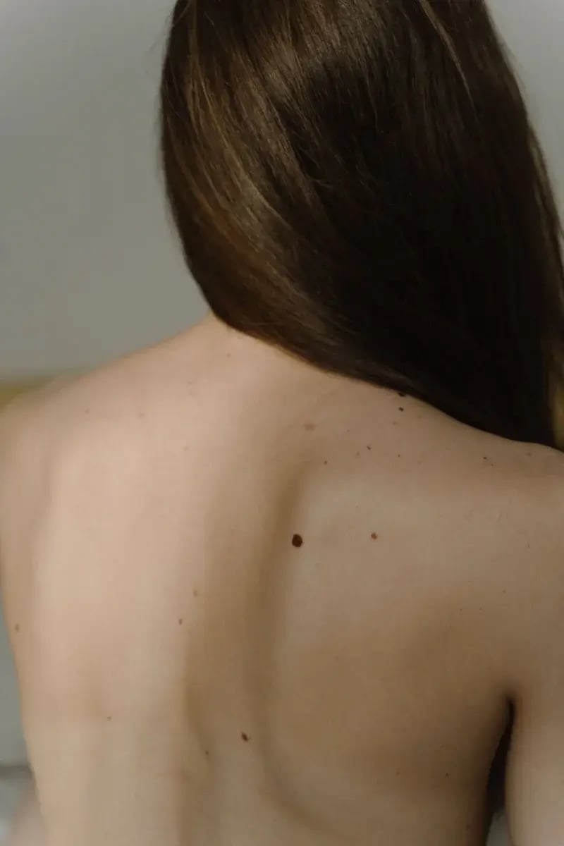 moles-on-back-skin-check