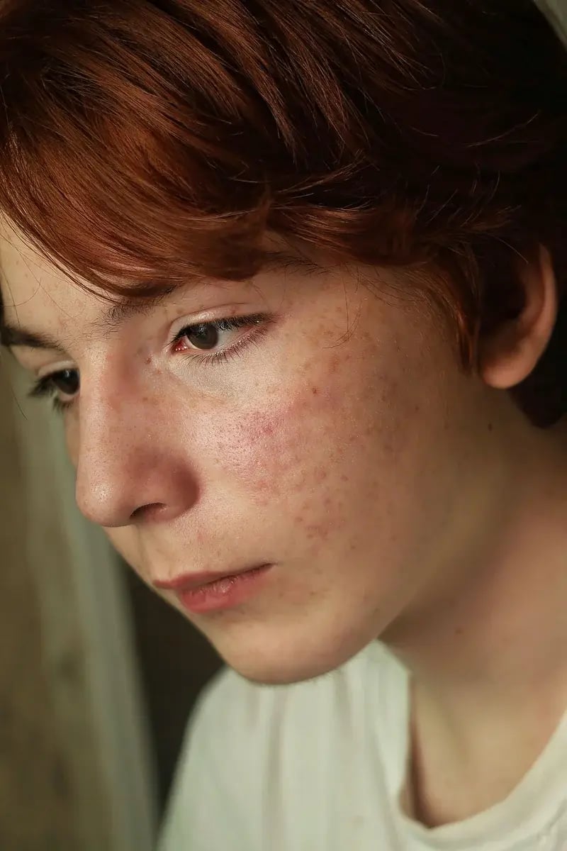 young-person-skin-redness-freckles